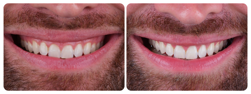 Imagem antes x depois 02