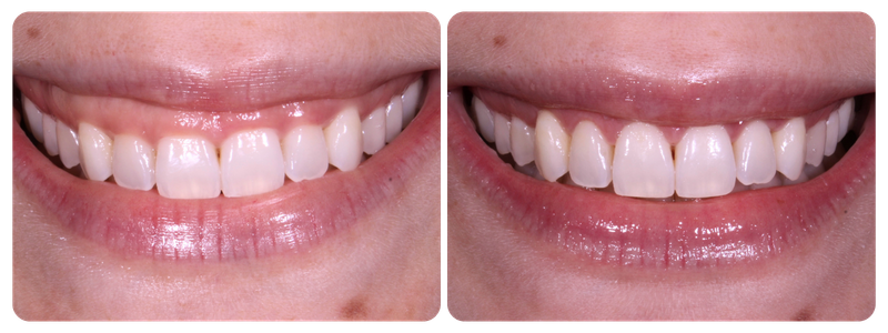 Imagem antes x depois 03